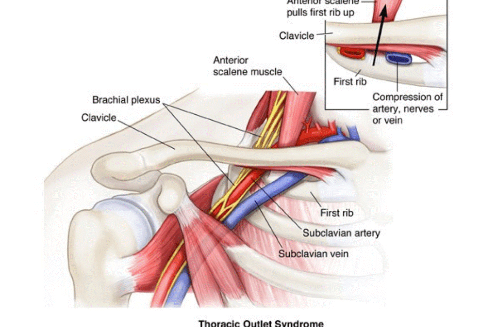 Thoracic Outlet Syndrome