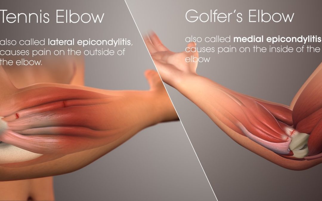 Tennis elbow Vs Golfer’s elbow