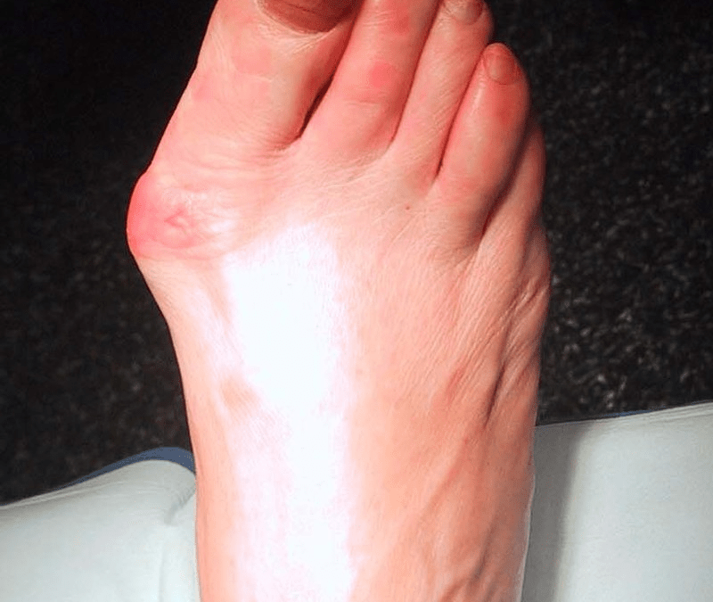 Hallux Valgus Deformity (aka Bunions)