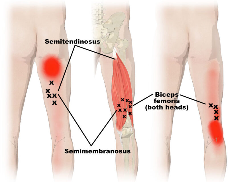 Who Is Susceptible to Hamstring Issues?
